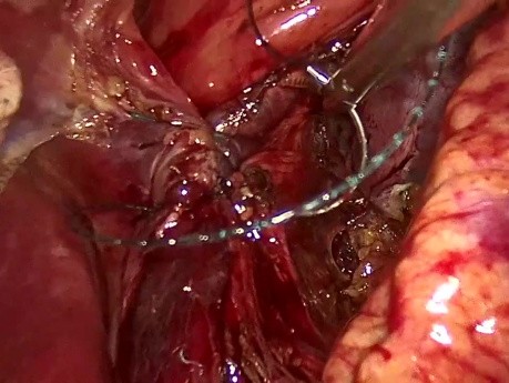 Axial Hiatal Hernia. Gastroesophageal Reflux Disease