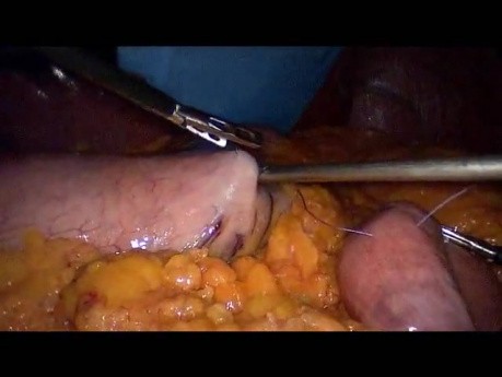 Laparoscopic Gastric Bypass - Part 1