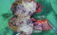 Small bowel obstruction due to Non Hodgkin's lymphoma 2