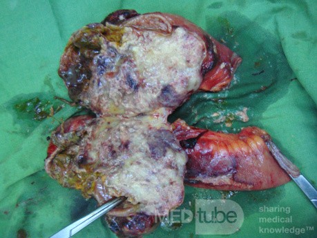 Small bowel obstruction due to Non Hodgkin's lymphoma 2