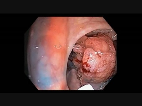 Colonoscopy Channel - Epinephrine Volume Reduction Of A Large Polyp