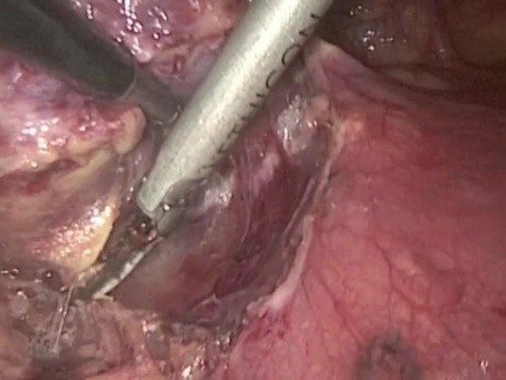 VATS thymoma removal
