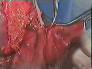 Gastric Cancer Surgery - Subtotal Proximal Gastrectomy