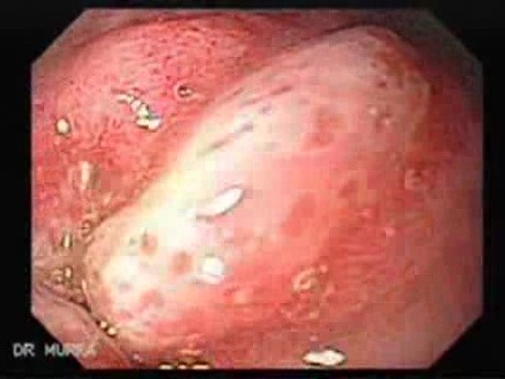 Duodenal Ulcer (3 of 4)