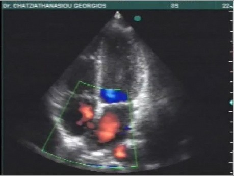 Cardiology Quiz Nr 3 ECG and Echocardiogram of a Patient With Congenital Heart Disease