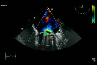 Mechanical Mitral Regurgitation