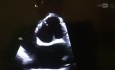 Bicuspid AV in Parasternal Short Axis View