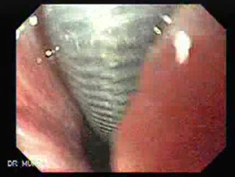 Adenocarcinoma of the cardias (8 of 14)