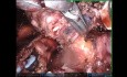 Right Bronchus Bronchoplasty - Challenging Case