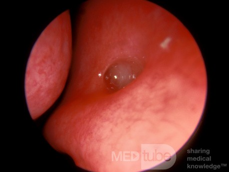 Jacobson's Organ