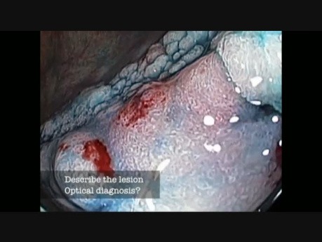 Colonoscopy Channel Quiz 18