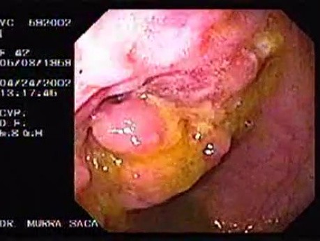 Crohn's Disease - Endoscopy (5 of 28)