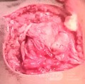 Meningocele in an 18-year-old patient