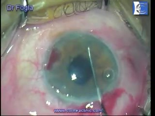 Endothelial keratoplasty -DMEK