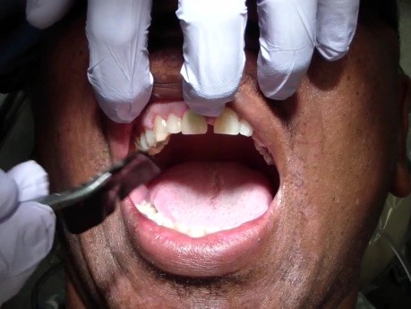 Reprep #3 (one six) for CAD/CAM - Check Occlusion