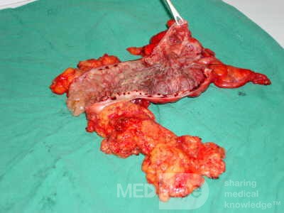 Severe case of Ischemic Colitis (16 of 19)