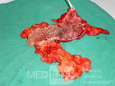 Severe case of Ischemic Colitis (16 of 19)
