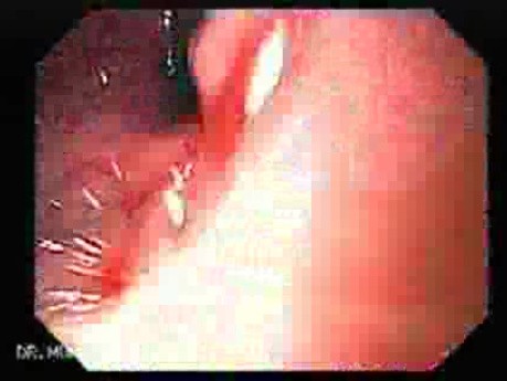 Adenocarcinoma of the Gastroesophageal Junction - Nonsurgical Lumen Restoriation