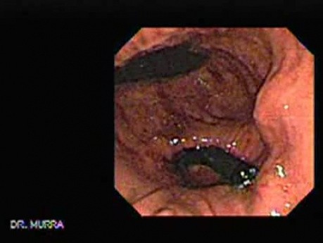 The Upper Gastrointestinal Tract - Video Endoscopic Sequence (6 of 6)