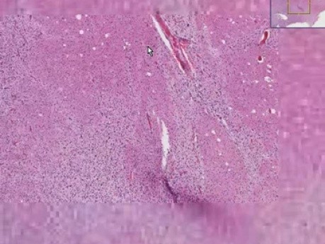 Glioma - Histopathology - Brainstem