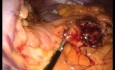 Laparo-Endoscopic Single Site (LESS) Distal Pancreatectomy & Splenectomy