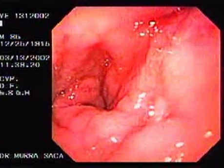 Duodenal Ulcer and Bleeding (3 of 4)