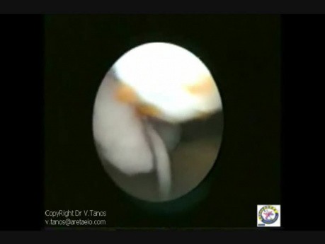 Trans-Vaginal Laparoscopy