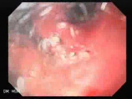 Scirrhous Gastric Carcinoma - Endoscopy (15 of 47)
