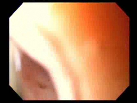 Massive Epistaxis - Second Absolute Alcohol Ablation -4/8