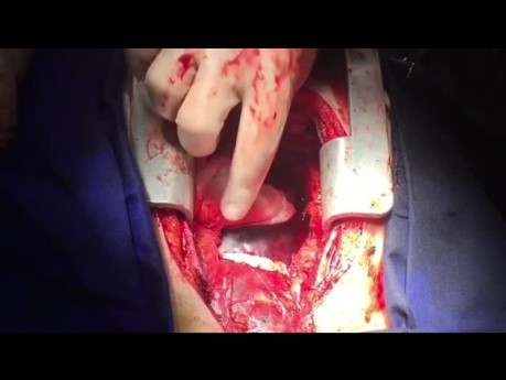 Damage Control Surgery for Patient With Ascending Aorta Dissection and Intimal Flap Rising