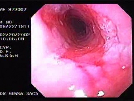 Barrett´s Esophagus (1 of 4)