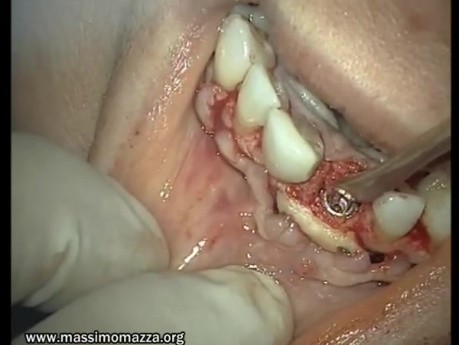 Regeneration Of Single Alveolar Process (3/3)