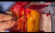 Management of Ascending Aorta Extensive Dissection with RCA Aneurysm