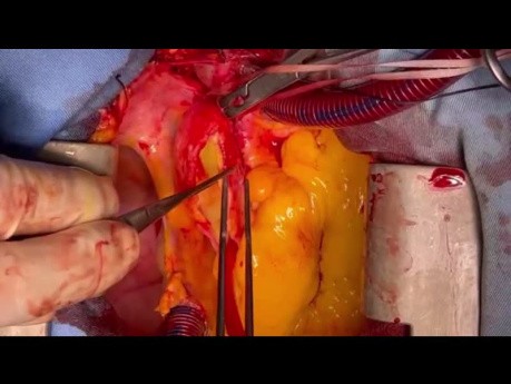 Management of Ascending Aorta Extensive Dissection with RCA Aneurysm