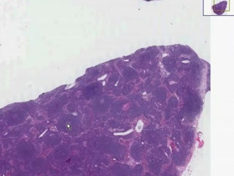 Mantle cell lymphoma - Histopathology - Lymph node