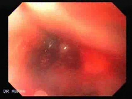 Synchronous Cancer (Gastric and Esophageal) - Assessment of the Superior Esophageal Sphincter