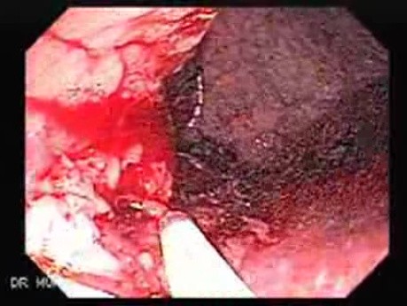 Tubulo - Villous Rectal Adenoma - Endoscopy (14 of 35)