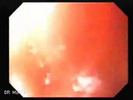 Squamous cell carcinoma of the larynx (3 of 4)