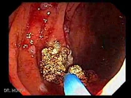 Giant Tubulo - Villous Adenoma (6 of 17)
