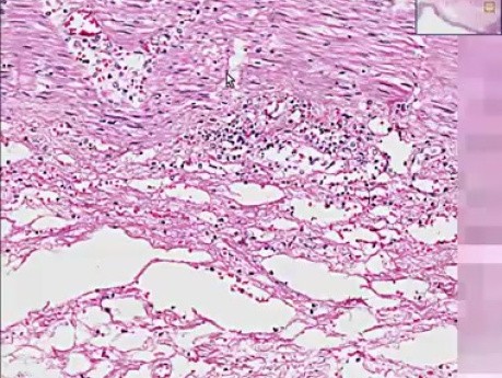 Ischemic enterocolitis
