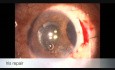 Bult Ocular Trauma, Phacotrabeculectomy and Iris Repair