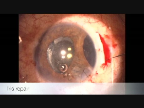 Bult Ocular Trauma, Phacotrabeculectomy and Iris Repair