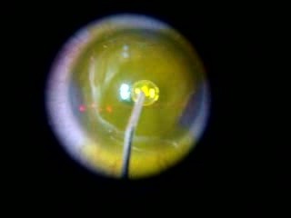 Keratoconus Case