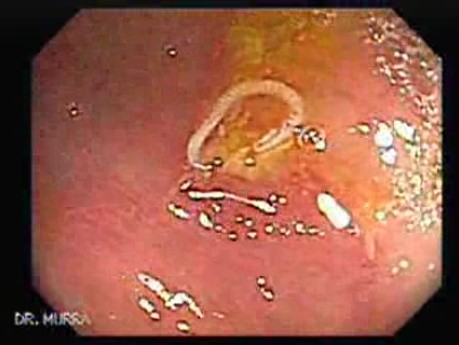 Schistosoma Mansoni in the Cecum (8 of 9)