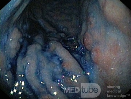 Unusual Appearance of Fundic Polyps. Chromoendoscopy. NET (5/6)