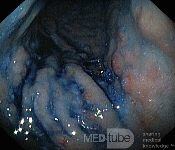 Unusual Appearance of Fundic Polyps. Chromoendoscopy. NET (5/6)