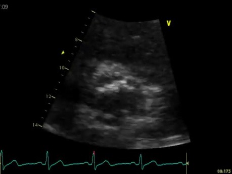 Coronary Artery Calcification - Aortic Cuspid of Right Coronary Artery