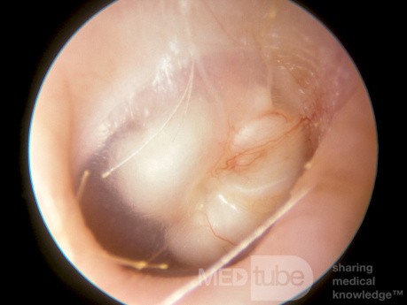 Large Congenital Cholesteatoma