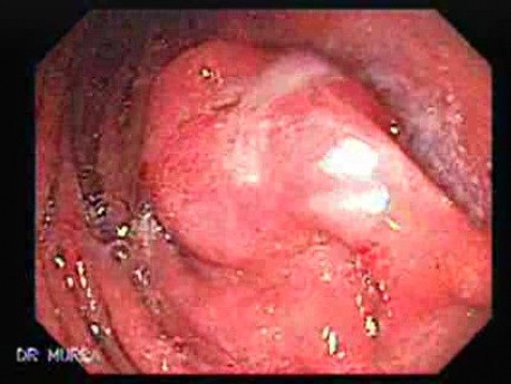 Early Gastric Cancer - Endoscopy (6 of 21)