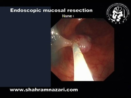 Sigmoid Colon Endoscopic Mucosal Resection